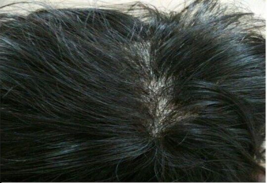 No-Fuss Stylish Men Hair Replacement System by Avani